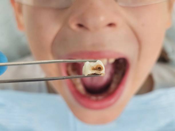 Best Emergency Root Canal Treatment in Westville, IN